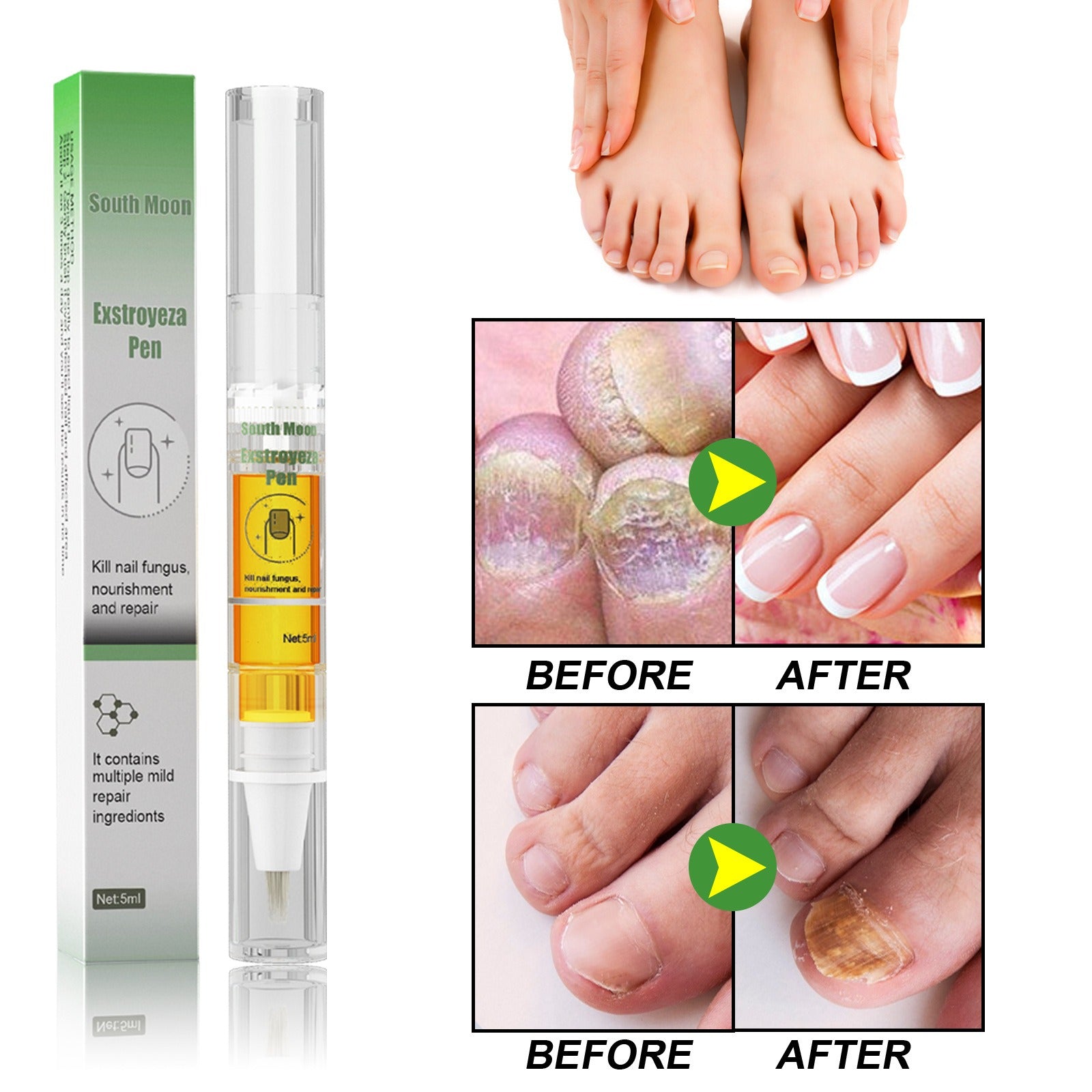 Nail Fungus Repair Pen – Heals & Restores Nails